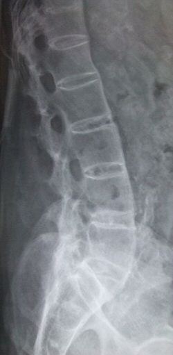 Lateral lumbar spine X-ray demonstrating ankylosing spondylitis