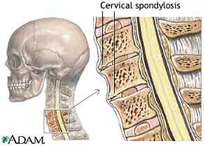 Cervical Spondylosis - Copyright remains with NLM and ADAM Inc.