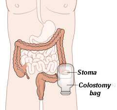 Intestines, colon and colostomy bag
