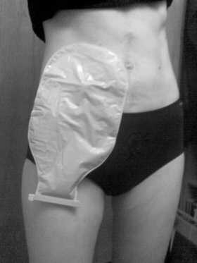 Female wearing a colostomy bag