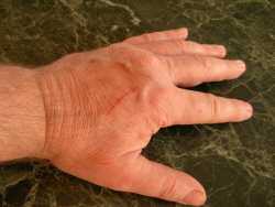 Healing a hand scratch with aloe