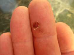 Healing a hand blister with aloe