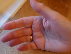 Healing a hand burn with aloe
