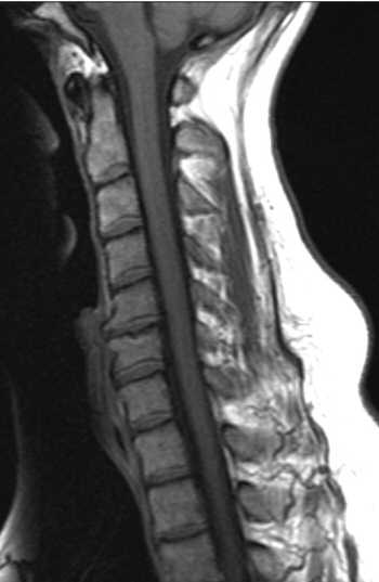 T1 weighted sagittal cervical spine MRI showing degenerative disc disease, osteophytes, and osteoarthritis of C5-C6