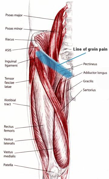 Showing where groin pain occurs at the top of the thigh