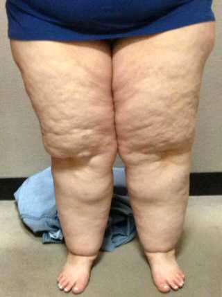 Lipoedema of the Legs