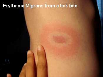 Erythema Migrans from Tick Bite