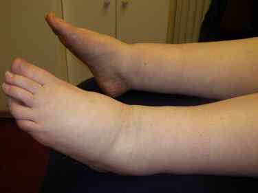 Lymphoedema of the legs and ankles