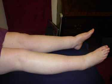 Lymphoedema of the legs and ankles