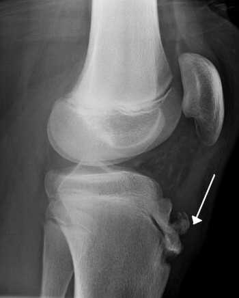 Radiograph of human knee with Osgood�Schlatter disease