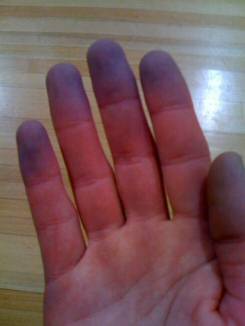 Hands blue from the cold may be caused by Raynaud's Syndrome