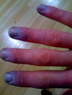Hands blue from the cold may be caused by Raynaud's Syndrome