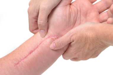Treatment for scarred, dysfunctional limbs