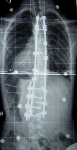 The Xray of a Scoliosis Patient Following Surgery