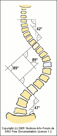 How to measure the degree of scoliosis using the Cobb angle