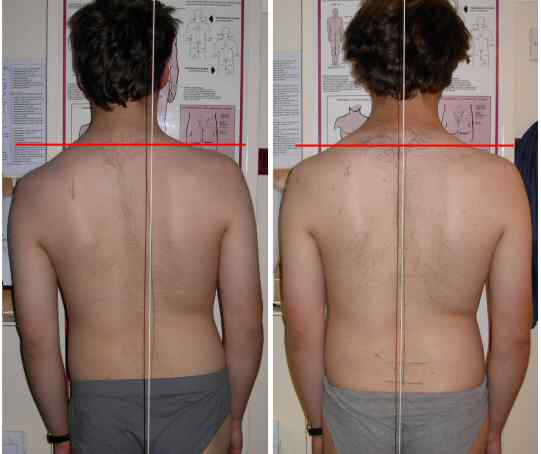 Scoliosis Comparison of Treatments Start to End